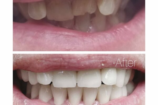 Fallegar Tennur - Fedasz Dental - Myndir2ef17eee-d6de-443f-8984-d32893a59ff6