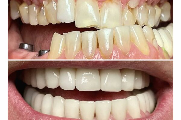 Fallegar Tennur - Fedasz Dental - Myndir64be950c-e6a0-4fa6-ae57-b67159c7c0e4