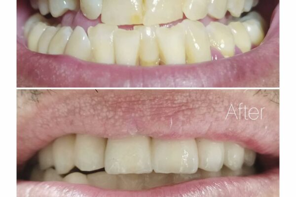 Fallegar Tennur - Fedasz Dental - Myndirefacb18d-0ba7-4efb-b9db-f69e409b0879