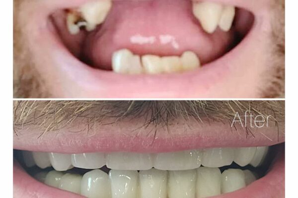 Fallegar Tennur - Fedasz Dental - Myndirf17ef40d-e7b0-4d81-956d-9fa4e0959ad1