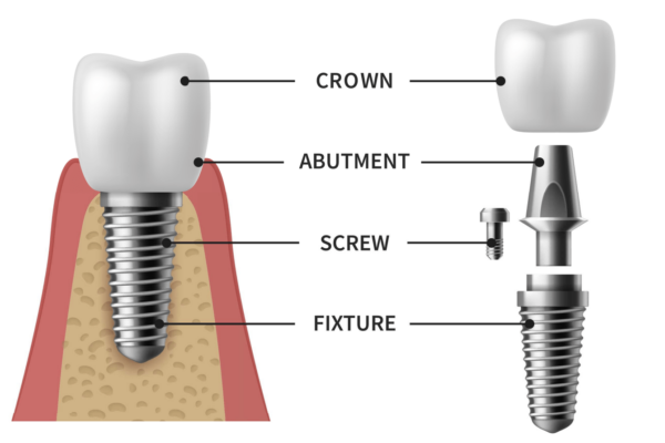 Implant parts